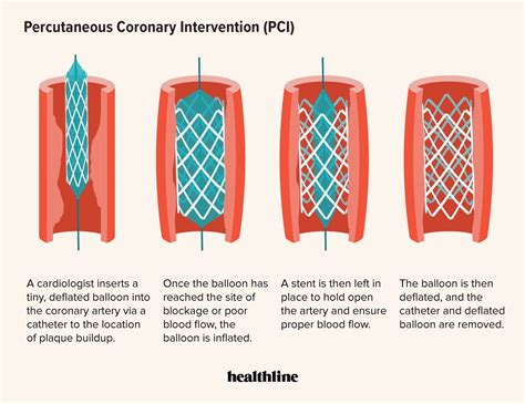 pci & toke|Percutaneous Coronary Intervention (PCI) .